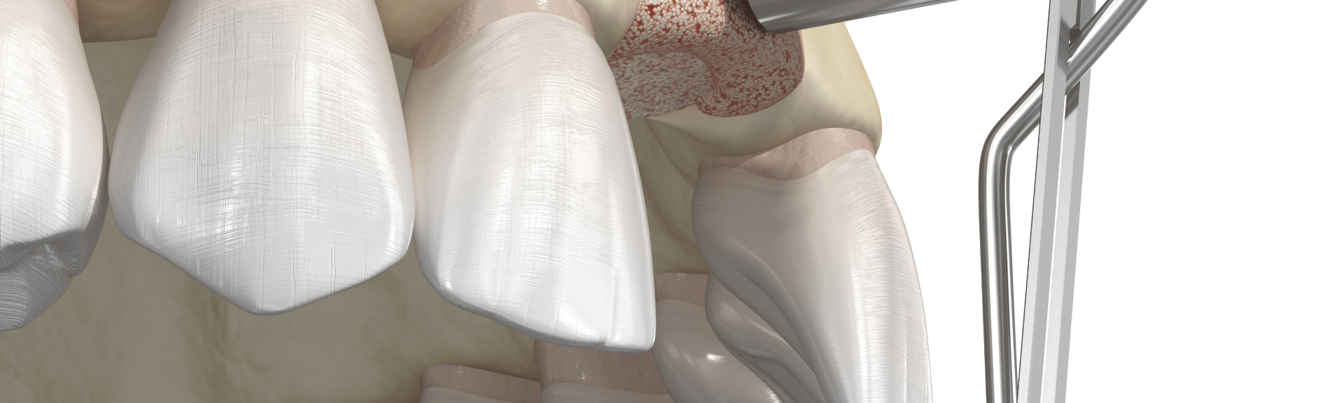 Dental bone graft surgery done at Park Smiles NYC dentist in upper east side