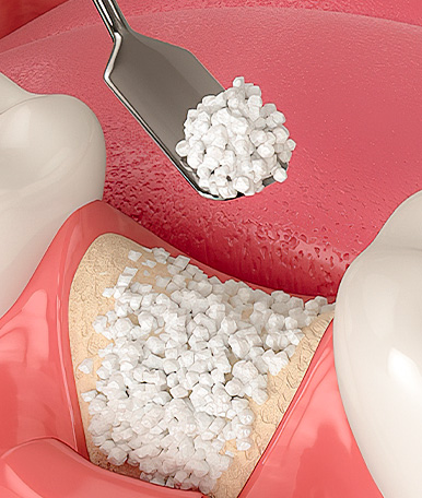 Cosmetic Dentistry-Bone grafting