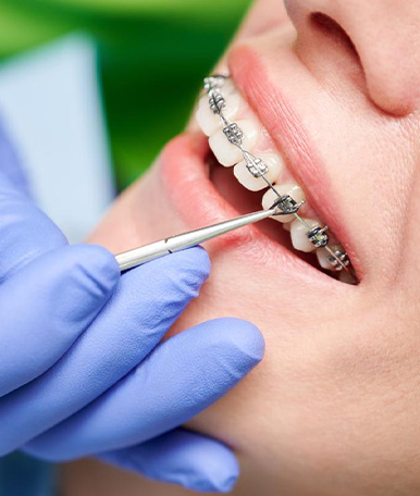 orthodontics-Accelerated orthodontics
