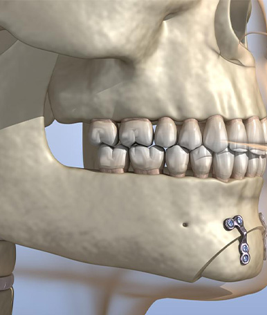 periodontics-Osseous surgery