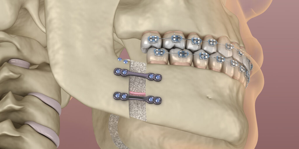 Mandibular Advancement surgery