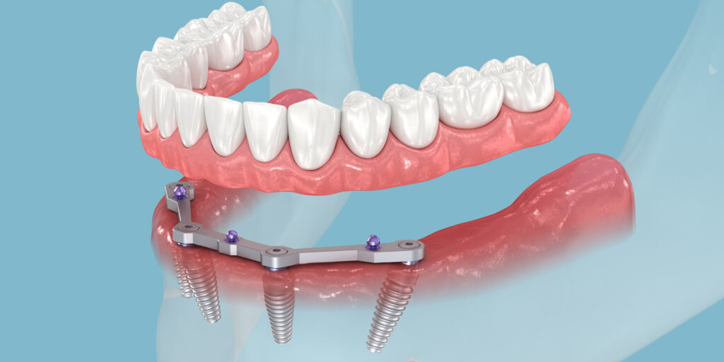 all on-4 dental implants