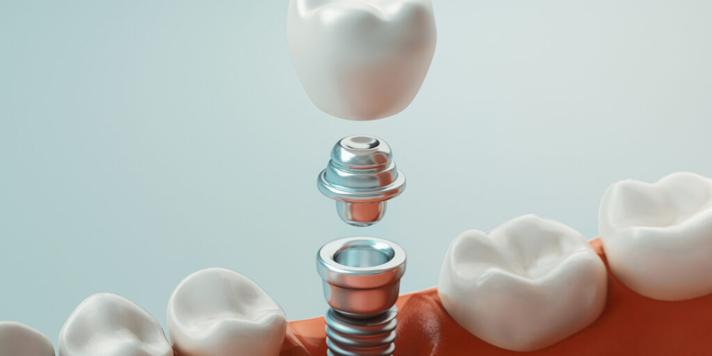 dental-implant