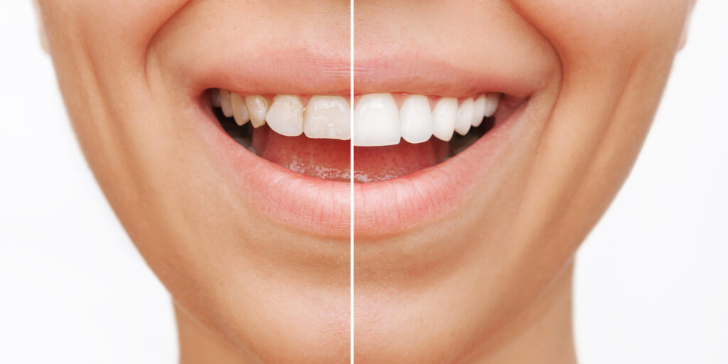 Smiling woman before and after veneers are installed