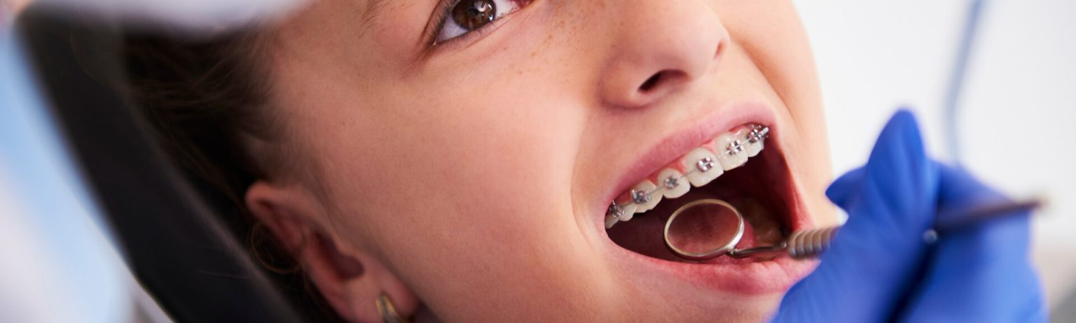 Early orthodontic treatment