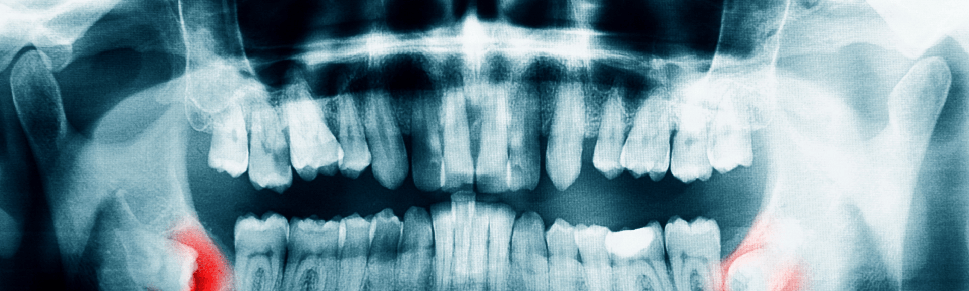 Impacted canine