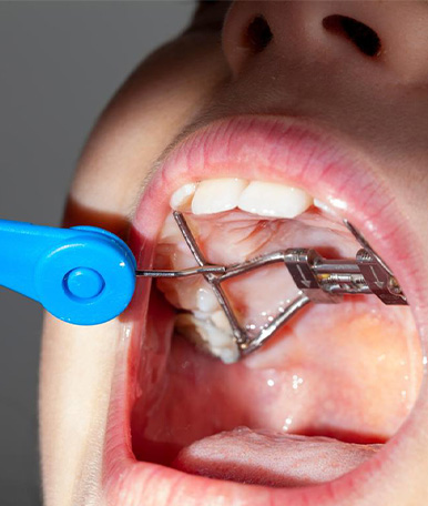 orthodontics-Rapid-palatal-expander