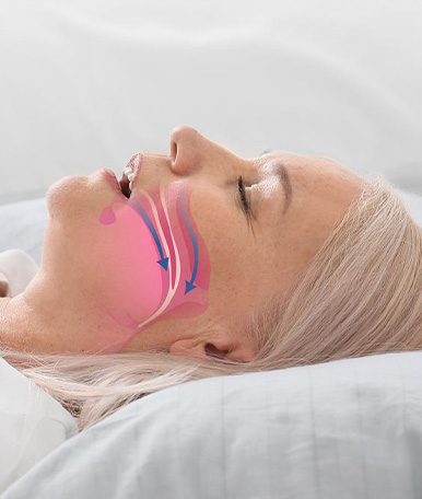 orthodontics-Treatment-for-obstructive-sleep-apnea