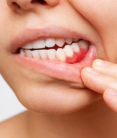 periodontics-Crown-lengthening