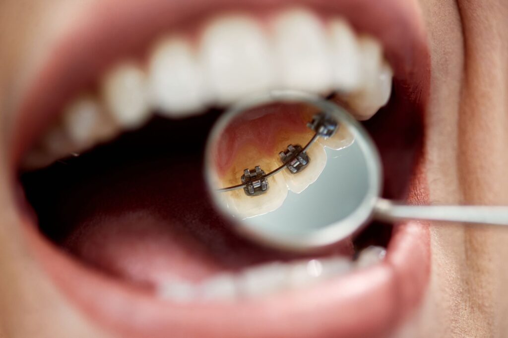 lingual braces shown