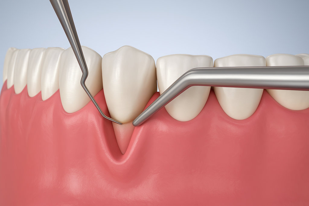 3D illustration of gum recession examination with dental tools, exposed tooth root and gingival recession concept in periodontal disease