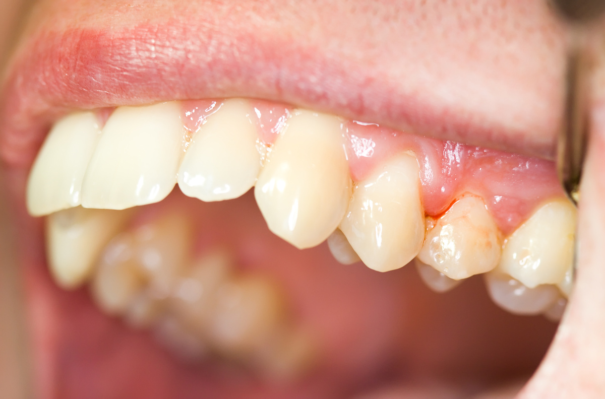 gingivitis